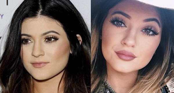 Kylie-Jenner-nose-job-2